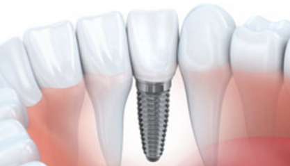 Dental Implants