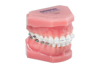 Fixed Orthodontic Appliances