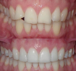 Composite Bonding 0 Composite Bonding