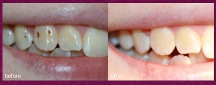 White Fillings TW9