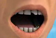 Broken Teeth
