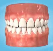 Dental Bridges