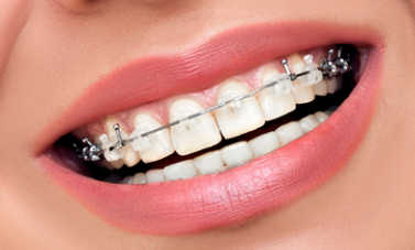 About Orthodontics and The Way It Works
