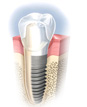 Dental Implants – Advanced Fixture