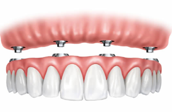 Dental Implants