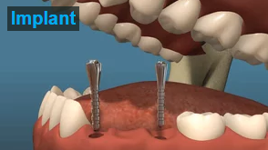 Dental Implants