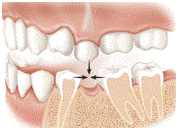 Replacing Missing Teeth