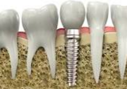 Dental Implants