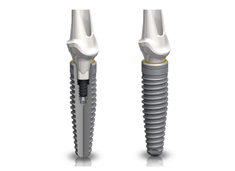 Dental Implants