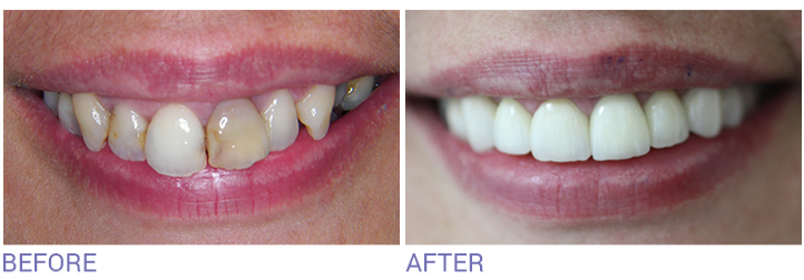 Dental Smile Makeover