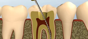 Root Canal Treatment