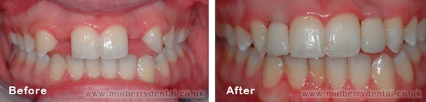 Dental Implants