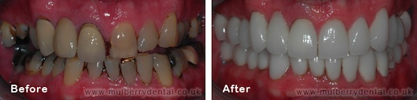 Dental Veneers