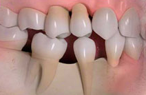 Dental Implant