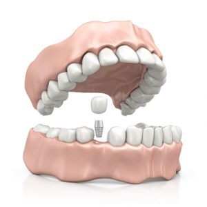 Dental Implants