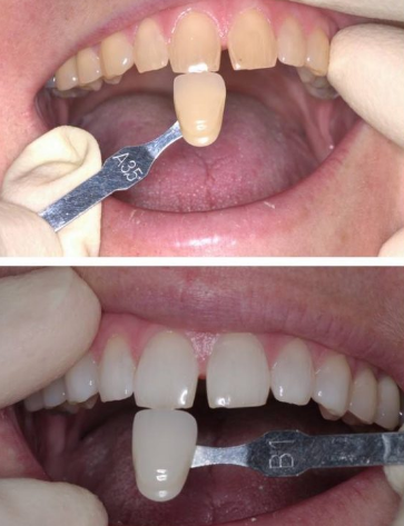 Tooth Whitening