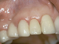 Crowns / Veneers