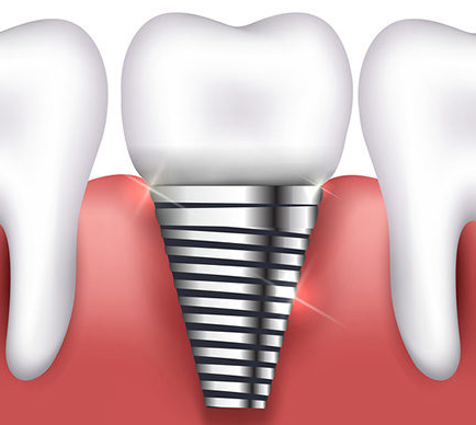 Dental Implants