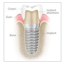 What is a dental implant?