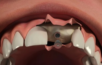 Dental Implants 0 Dental Implants