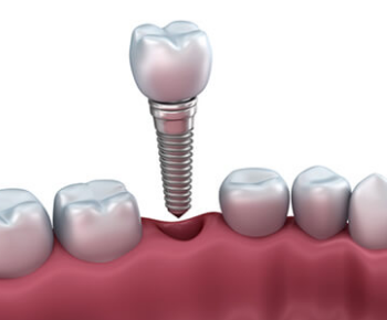 Dental Implants