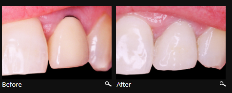 Why select Metal Free Crowns and Bridges? 0 Why select Metal Free Crowns and Bridges?