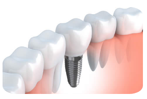 Dental Implants