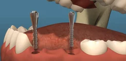 Dental Implants 0 Dental Implants