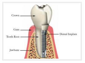 Dental Implants