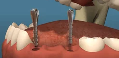 Dental Implants