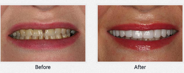 Porcelain Veneers