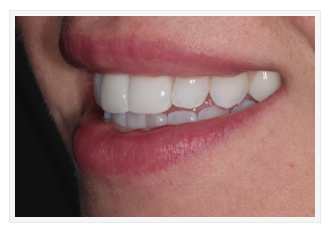 Dental Veneers