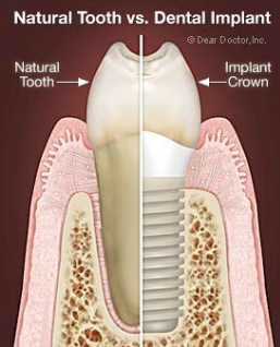 Dental Implants