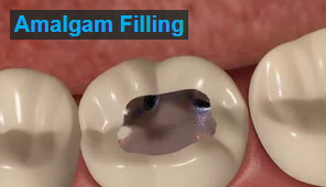 Amalgam Fillings