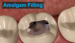 Amalgam Fillings