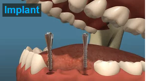 Dental Implants