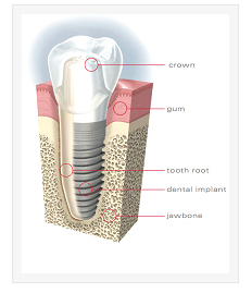 Dental Implants