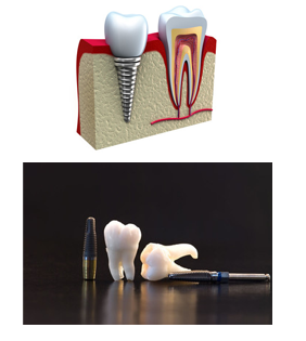 Dental Implants