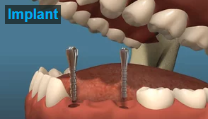 Dental Implants