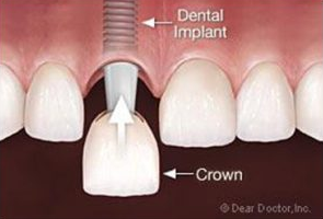 Dental Implants