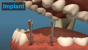 Dental Implants