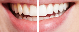 Teeth Whitening