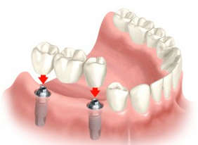 Dental Implants