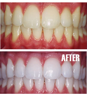 Teeth Whitening Portishead