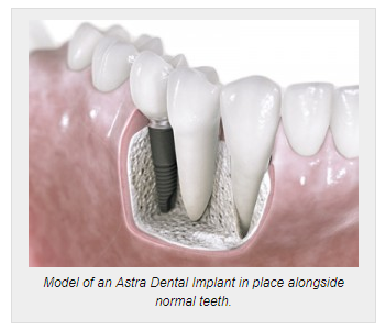 Dental Implants