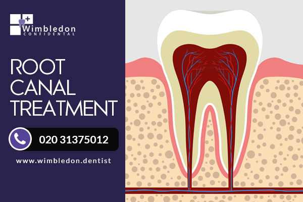 Root Canal Treatment