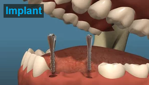 Dental Implants 0 Dental Implants