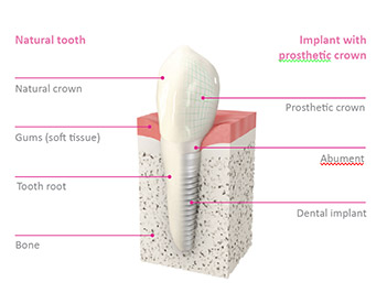 Why Dental Implants?