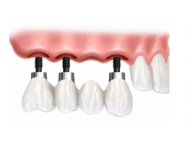 Dental Implants