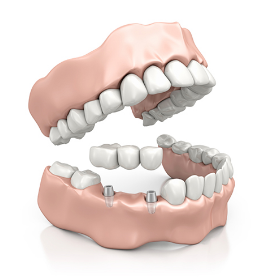 Dental Bridges